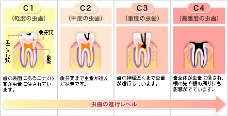 虫歯の進行レベルチェック